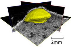 Tumeur image ultrasonore 3D HF 50MHz